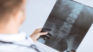 What is a Myelogram