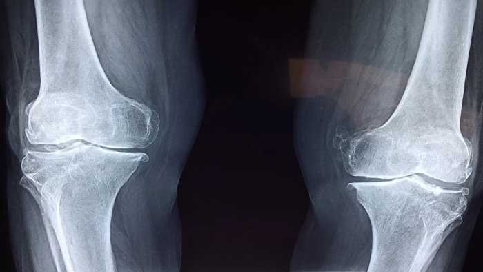 How to Cure Gout in Knee