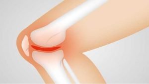 How to Cure Osteoarthritis