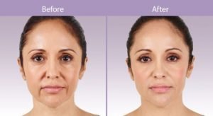 Check out to know more about the Vycross Technology Facial Fillers